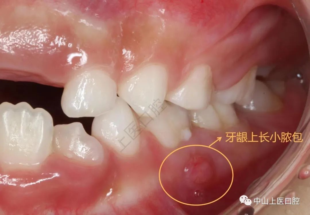 儿童牙龈反复长脓包怎么办？