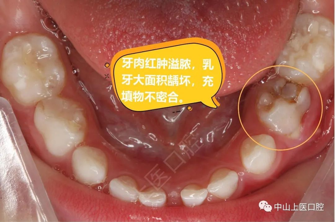 儿童牙龈反复长脓包怎么办？