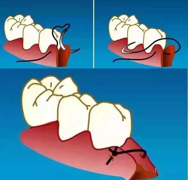 牙周治疗缝针、缝线选择和缝合方法！