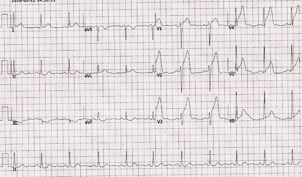 这些临床常见的心电图危急值识别，你掌握了吗？