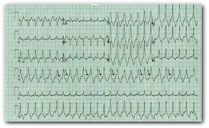 这些临床常见的心电图危急值识别，你掌握了吗？