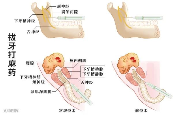 七种常用口腔阻滞麻醉的方法大全！