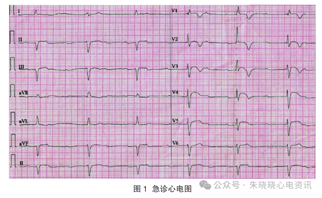 暴发性心肌炎致三度AVB及ST段抬高