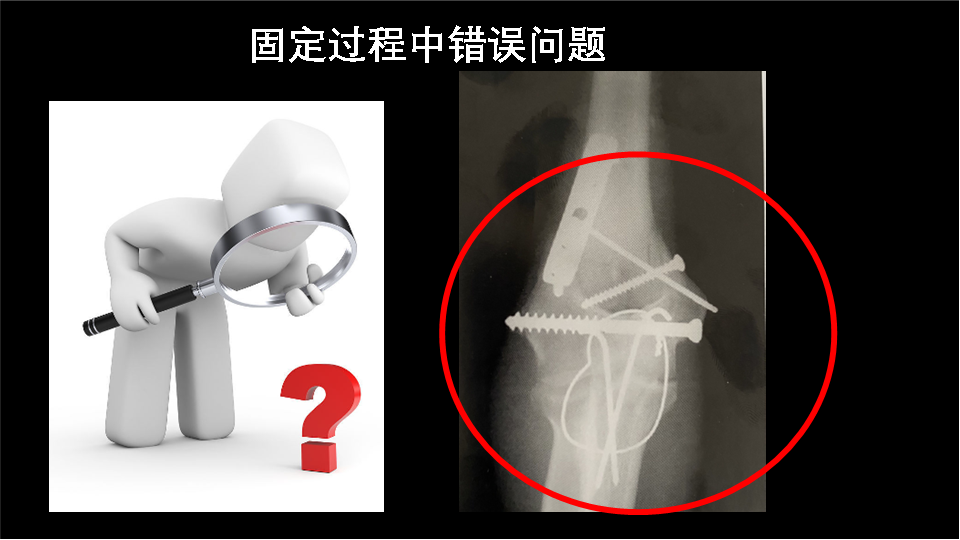 从一例失败的肱骨远端骨折案例中整理正确的手术步骤（图文解说）