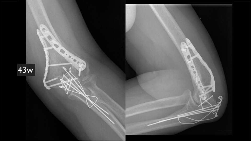 从一例失败的肱骨远端骨折案例中整理正确的手术步骤（图文解说）