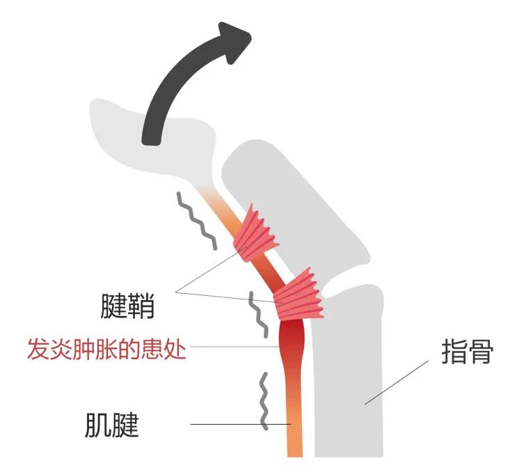 桡骨茎突狭窄性腱鞘炎还能自我治疗？关键要注意这一点！