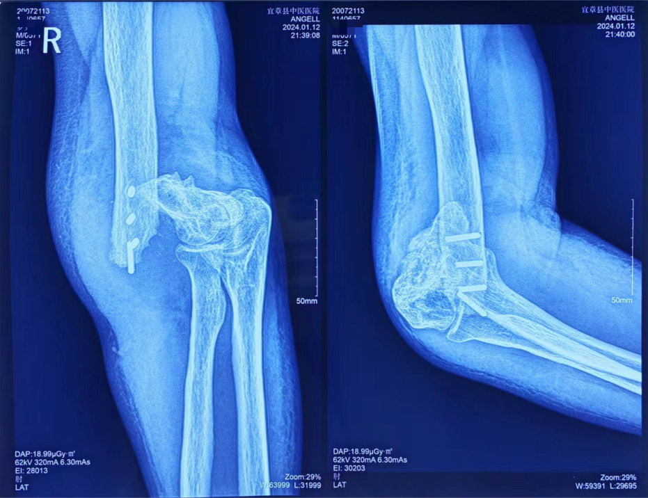 肘关节置换术治疗中老年肱骨髁上陈旧性骨折并创伤性肘关节炎