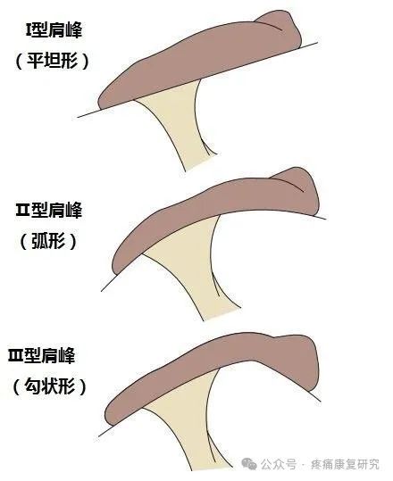 肩袖损伤的