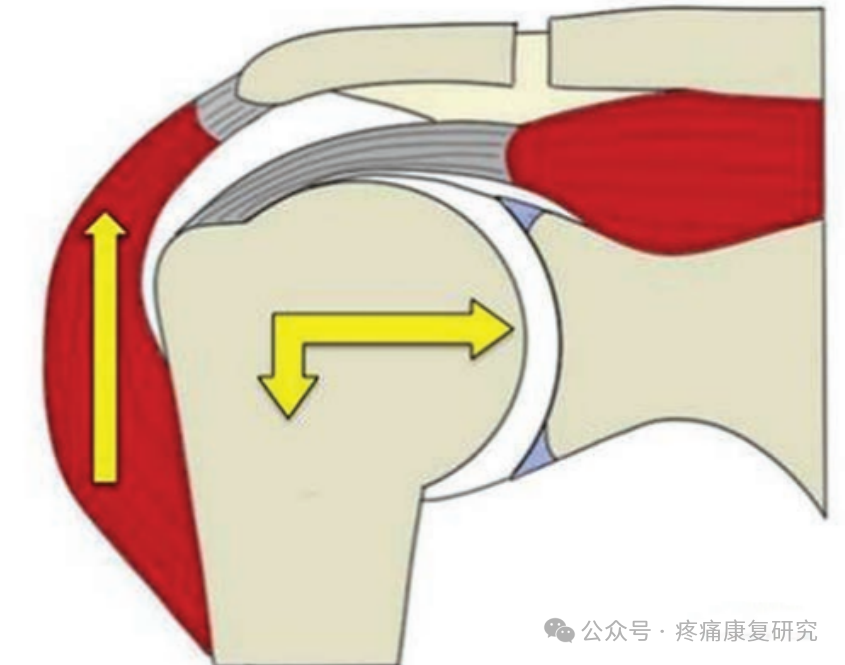 肩袖损伤的