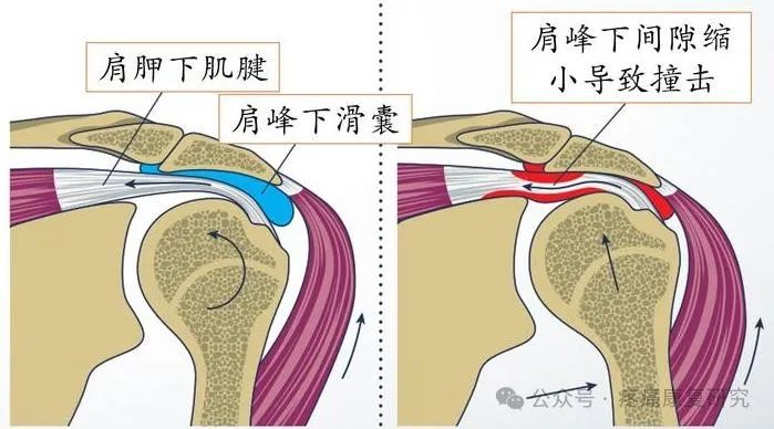 肩袖损伤的