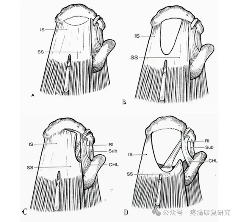 肩袖损伤的