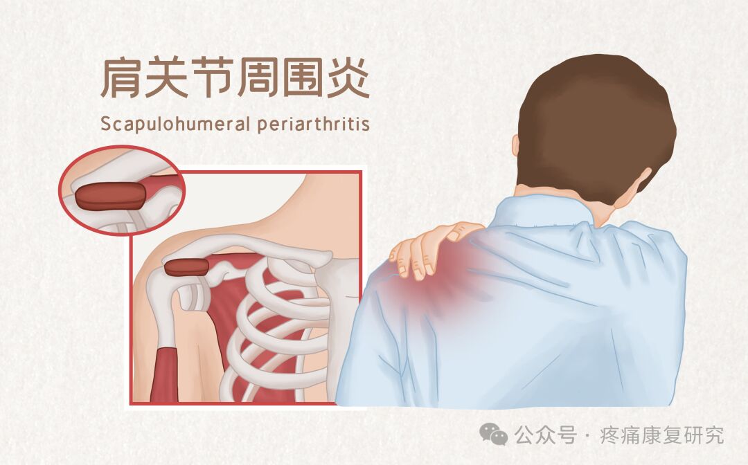 肩袖损伤的