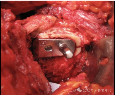 全髋关节置换的术中股骨距骨折