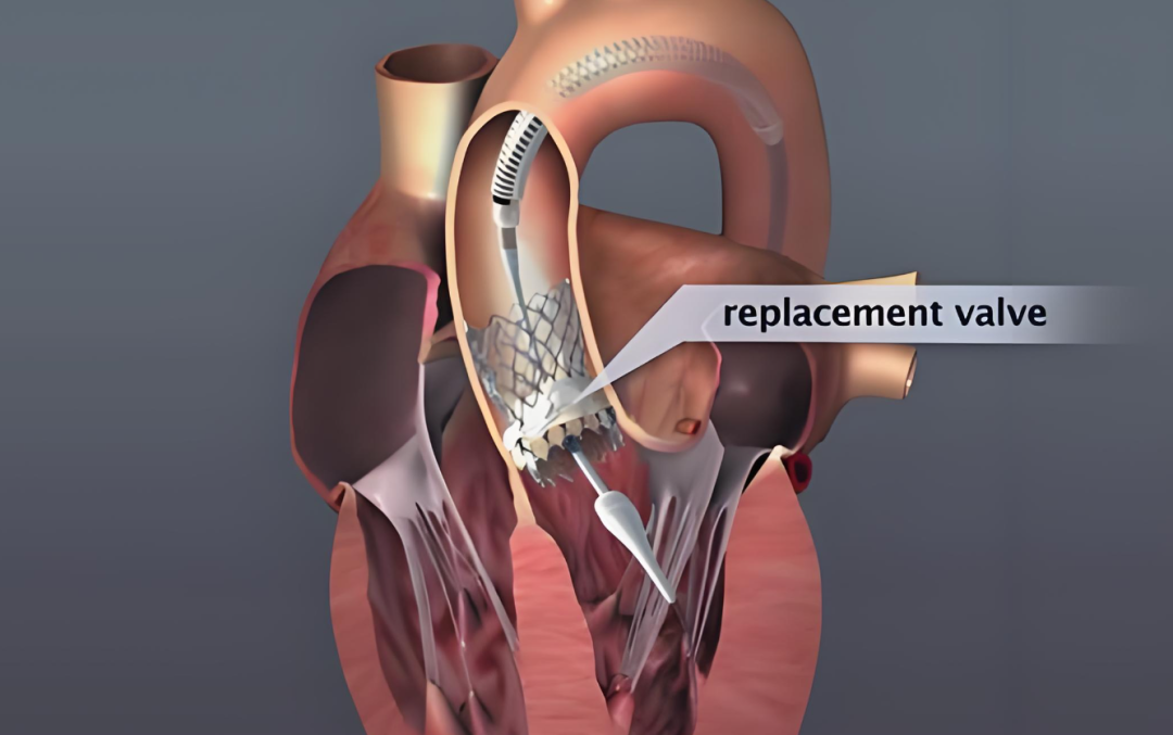 应对人工瓣膜瓣周漏，掌握这些技巧，胸有成竹迎接挑战！