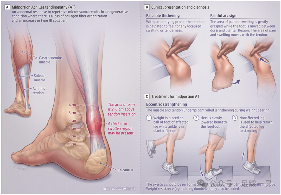 【JAMA​综述】三大常见的疼痛相关足踝疾病