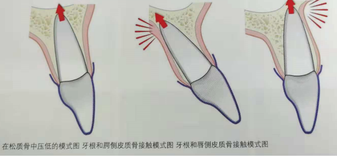 口腔正畸无托槽隐形矫治技术-适应症解析