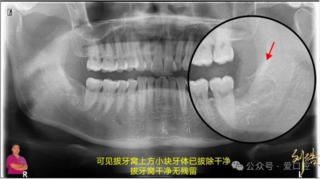 上颌窦黏膜穿孔的分类、处理方法及研究进展