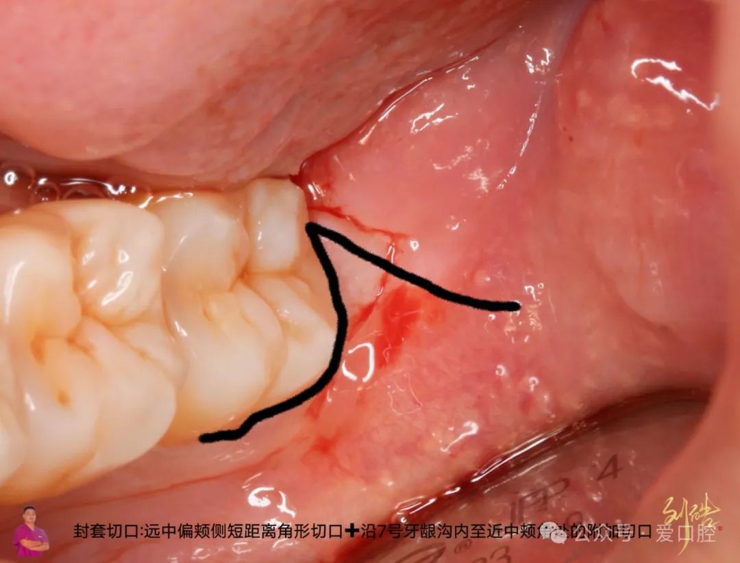 上颌窦黏膜穿孔的分类、处理方法及研究进展