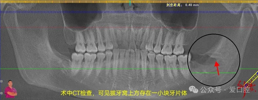 上颌窦黏膜穿孔的分类、处理方法及研究进展