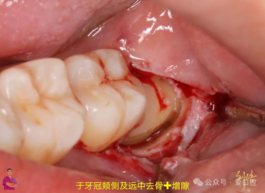 上颌窦黏膜穿孔的分类、处理方法及研究进展