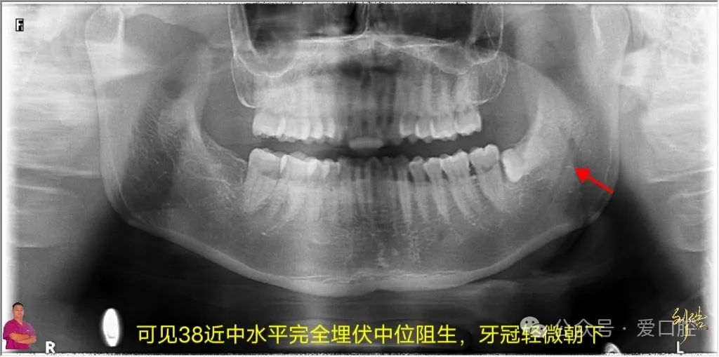 上颌窦黏膜穿孔的分类、处理方法及研究进展