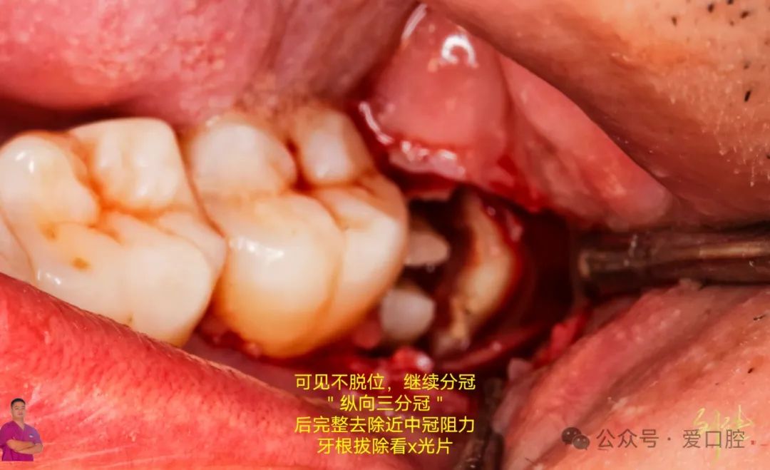 上颌窦黏膜穿孔的分类、处理方法及研究进展