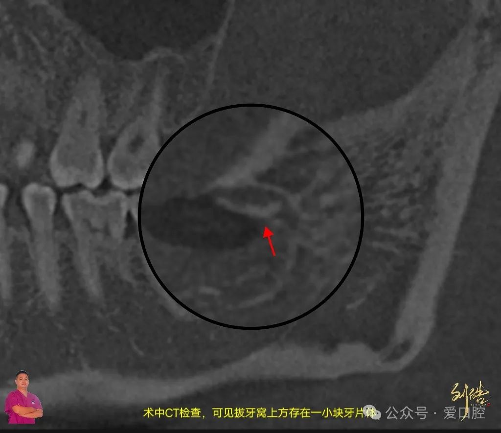 上颌窦黏膜穿孔的分类、处理方法及研究进展