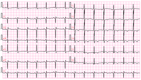 掌握这22张心电图，精通Q波鉴别诊断！