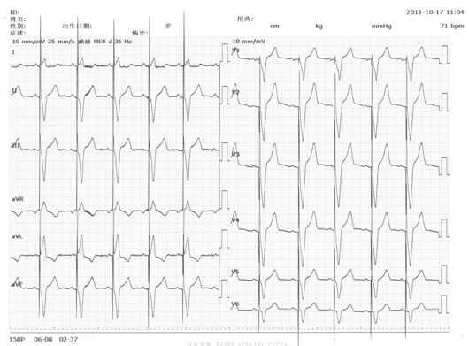 掌握这22张心电图，精通Q波鉴别诊断！