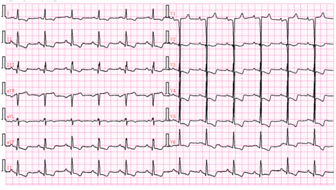 掌握这22张心电图，精通Q波鉴别诊断！