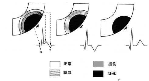掌握这22张心电图，精通Q波鉴别诊断！