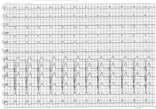 掌握这22张心电图，精通Q波鉴别诊断！