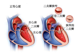 一文读懂心脏瓣膜病的临床诊疗进展