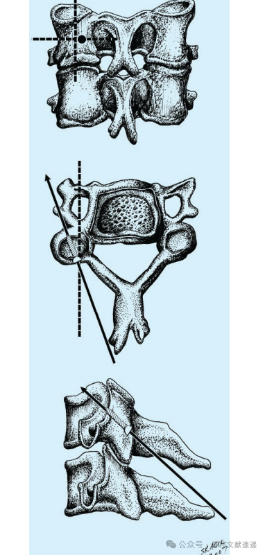5种颈椎侧块螺钉置入技术