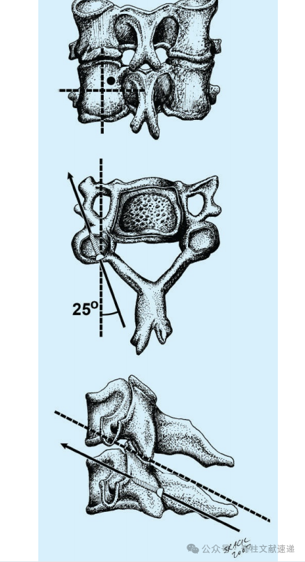 5种颈椎侧块螺钉置入技术