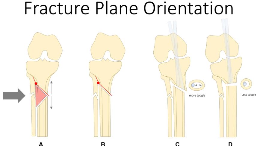 【手术技术】如何避免胫骨近端骨折髓内钉对位不良