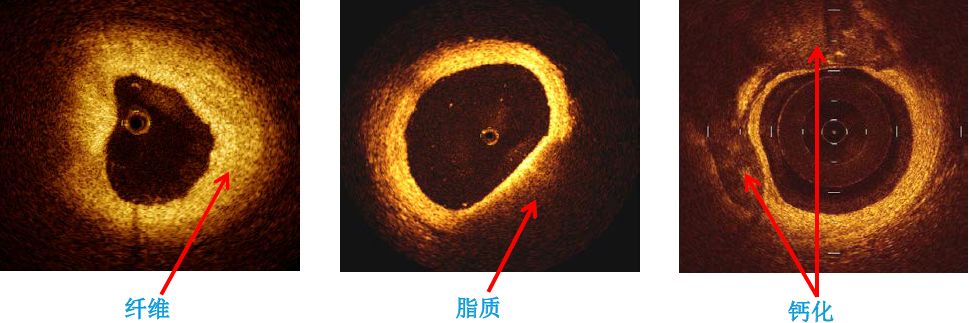 一文梳理冠心病常用的诊断方法