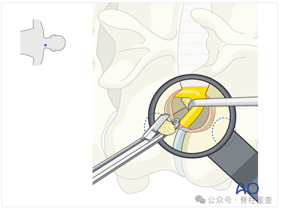 【文献阅读】后路显微镜通道下颈椎间孔减压术