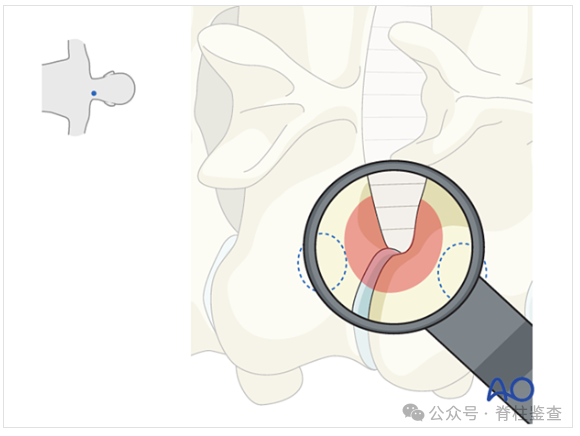 【文献阅读】后路显微镜通道下颈椎间孔减压术