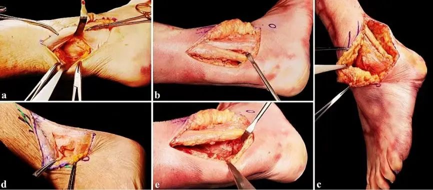 图文并茂：分享一种踝关节手术入路：后-前踝延伸外侧入路