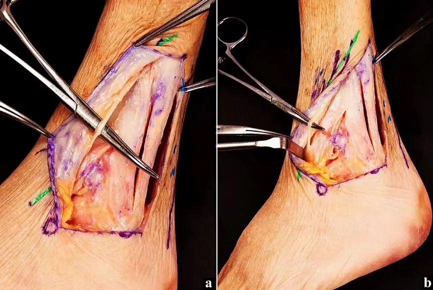 图文并茂：分享一种踝关节手术入路：后-前踝延伸外侧入路