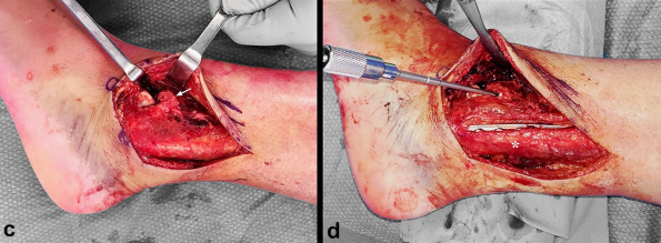 图文并茂：分享一种踝关节手术入路：后-前踝延伸外侧入路