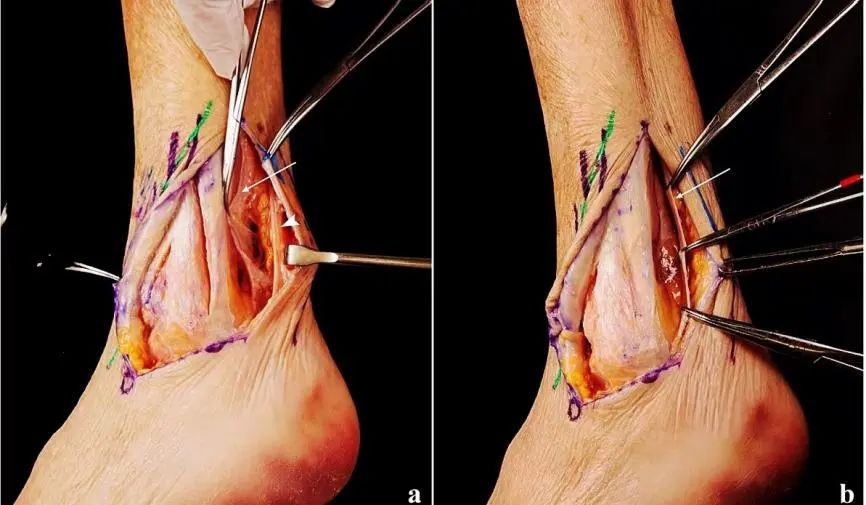 图文并茂：分享一种踝关节手术入路：后-前踝延伸外侧入路