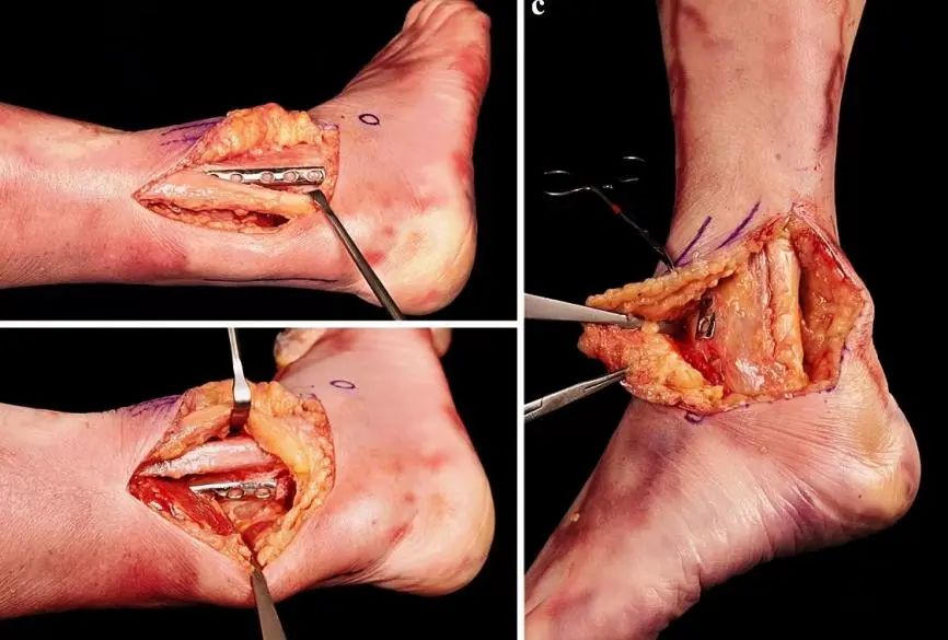 图文并茂：分享一种踝关节手术入路：后-前踝延伸外侧入路