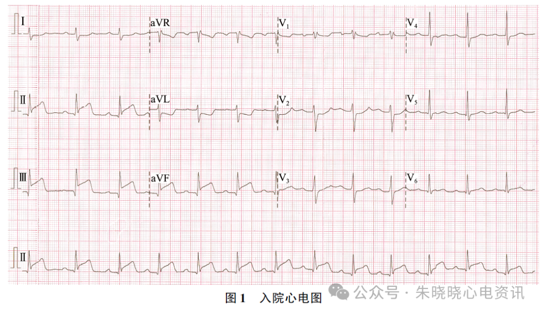 【案例分析】心电图ST段极快速下降