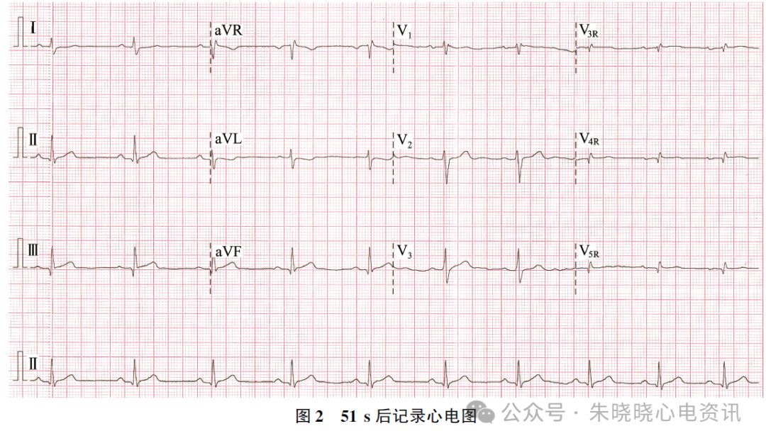 【案例分析】心电图ST段极快速下降
