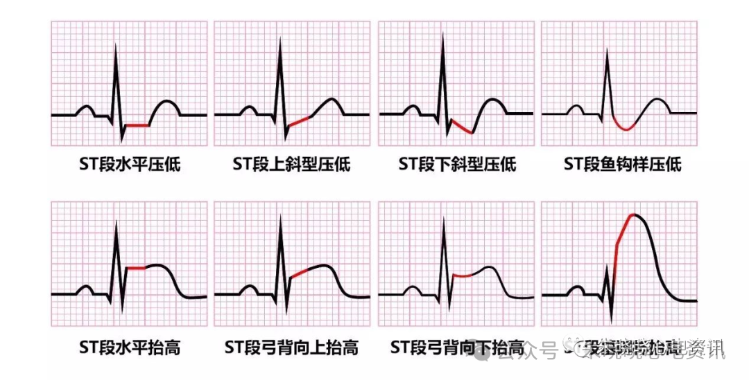 【案例分析】心电图ST段极快速下降