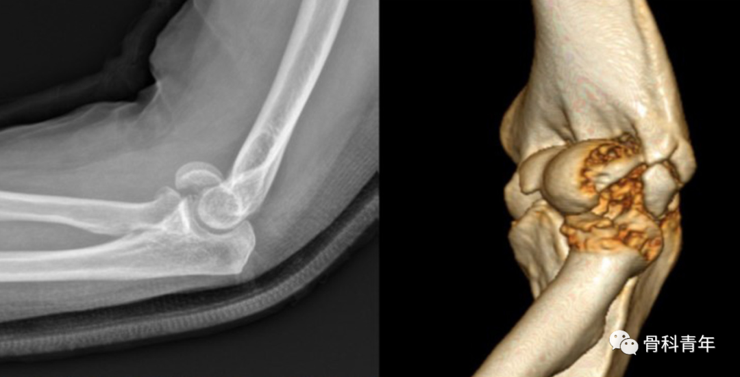 肘关节“接吻骨折”的损伤机制与临床特点