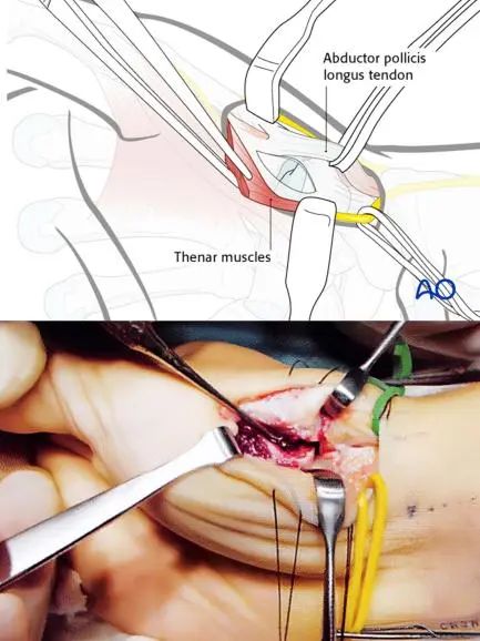 图文详解治疗Bennett骨折的掌侧入路