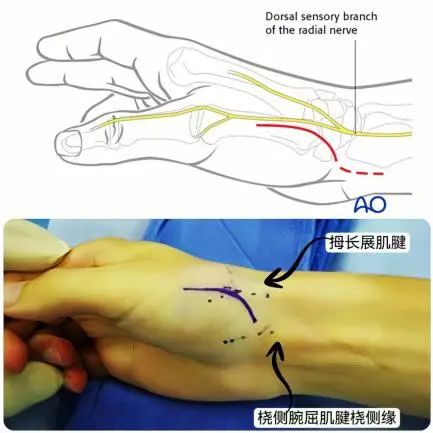 图文详解治疗Bennett骨折的掌侧入路